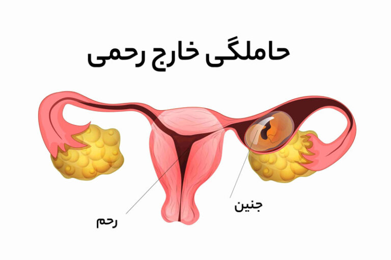 حاملگی خارچ رحمی