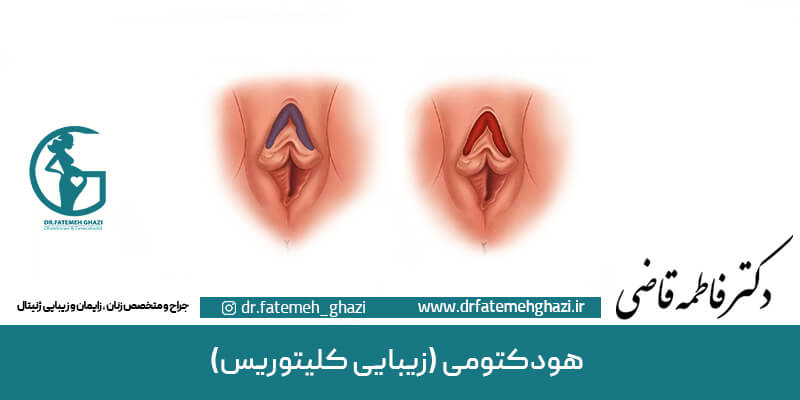 عمل هودکتومی