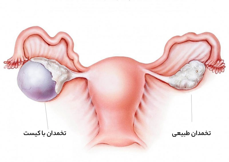 کیست تخمدان