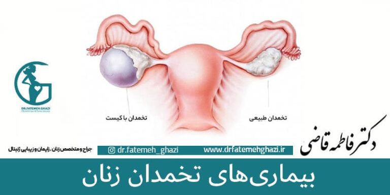 بیماری های تخمدان -تهرانپارس
