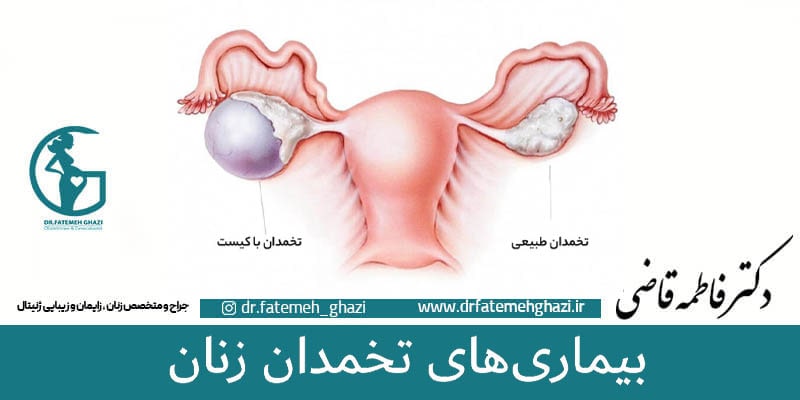 بیماری های تخمدان -تهرانپارس